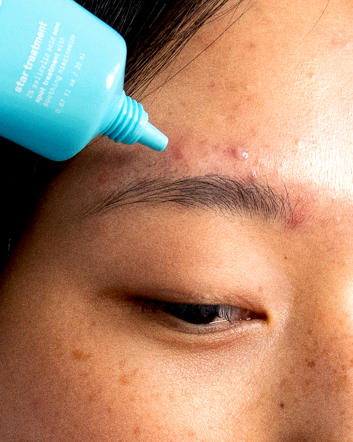A person applying Starface Star Treatment™ to a spot. A 2% salicylic acid gel that shrinks pimples and reduces redness.